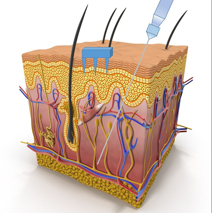 A study by Sandia National Laboratories and the University of New Mexico uses tiny microneedles that sip fluid in the middle layer of skin between the layer of dead skin cells and above where veins and nerves reside. Therefore, they’re far less painful than traditional hypodermic needles.